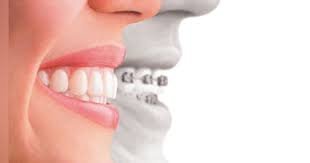  Aligners