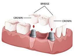  Crowns
