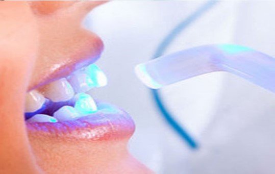 Cosmetic Laser Dentistry