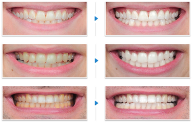 Laser Teeth whitening