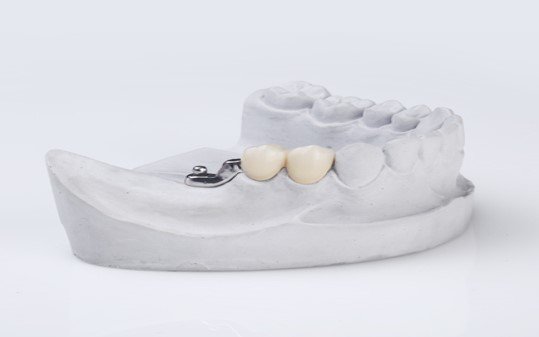 Precision Attachment Dentures