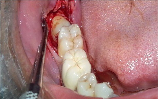 Surgical Extraction