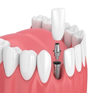Prosthodontics Dental Implants